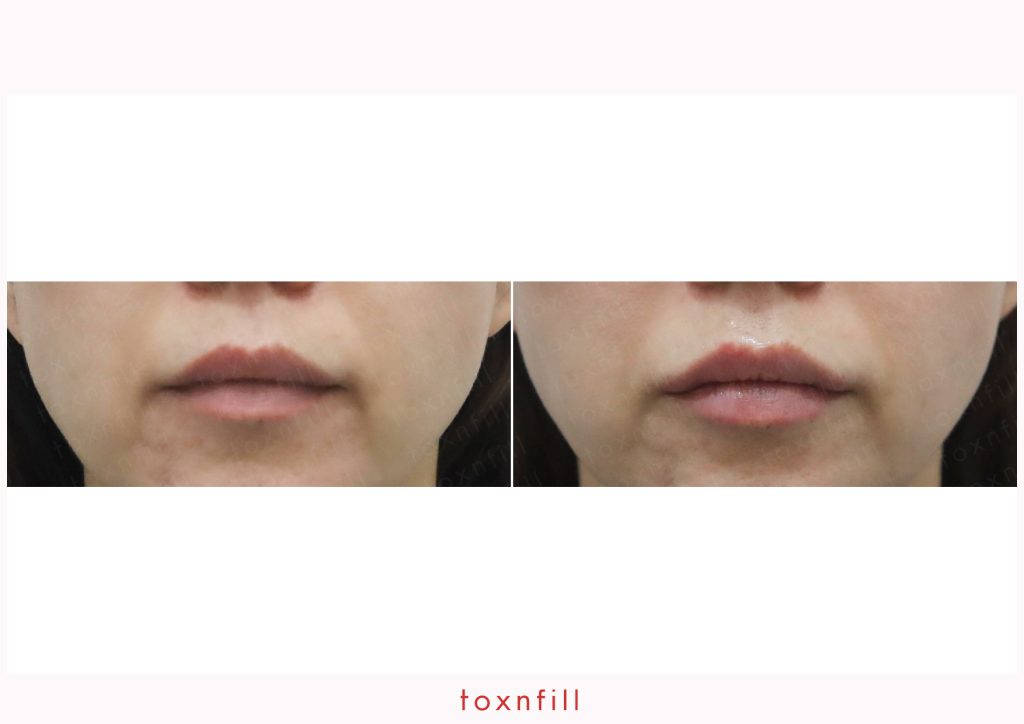 toxnfill bna 1
