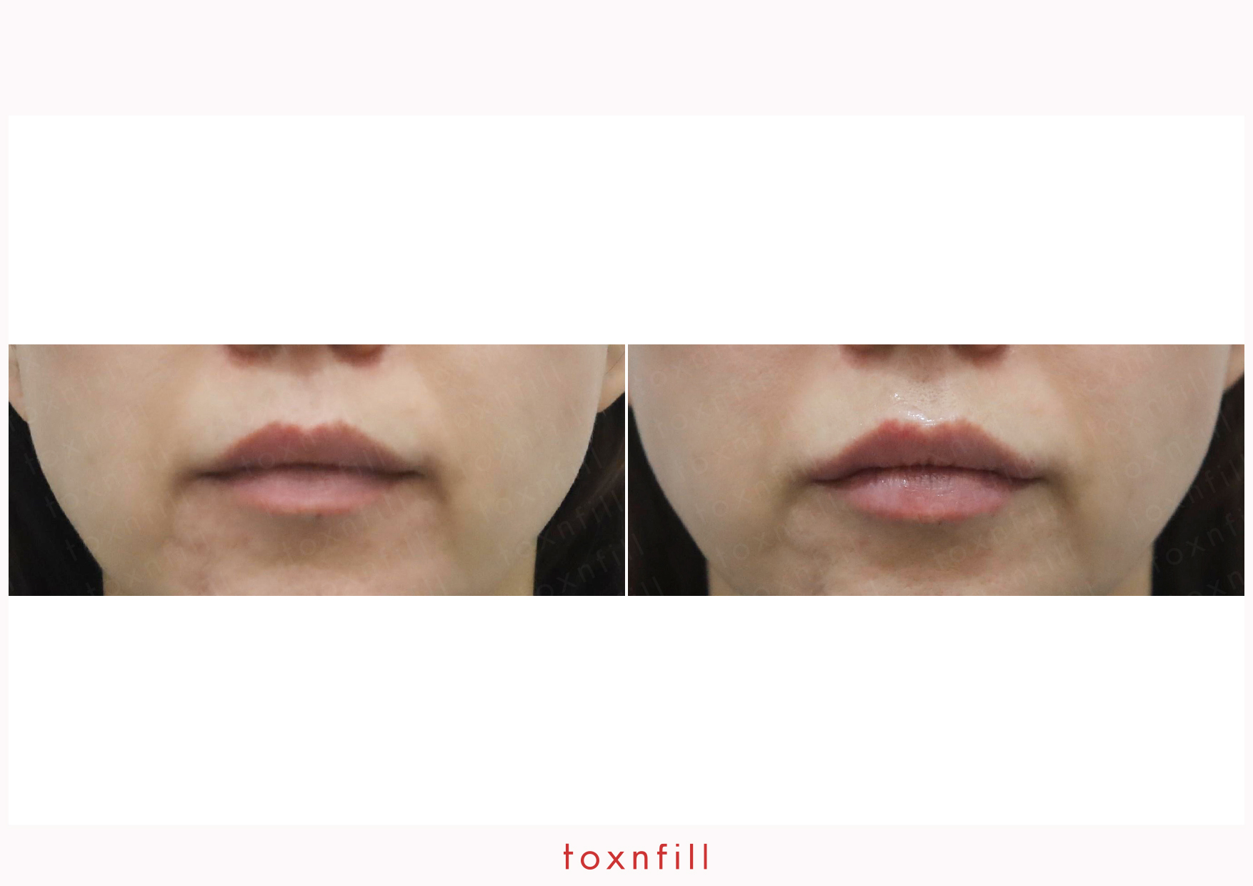 Toxnfill 명동점 입술 충전 수술 전후 비교 (사진은 참고용으로만 사용됨)