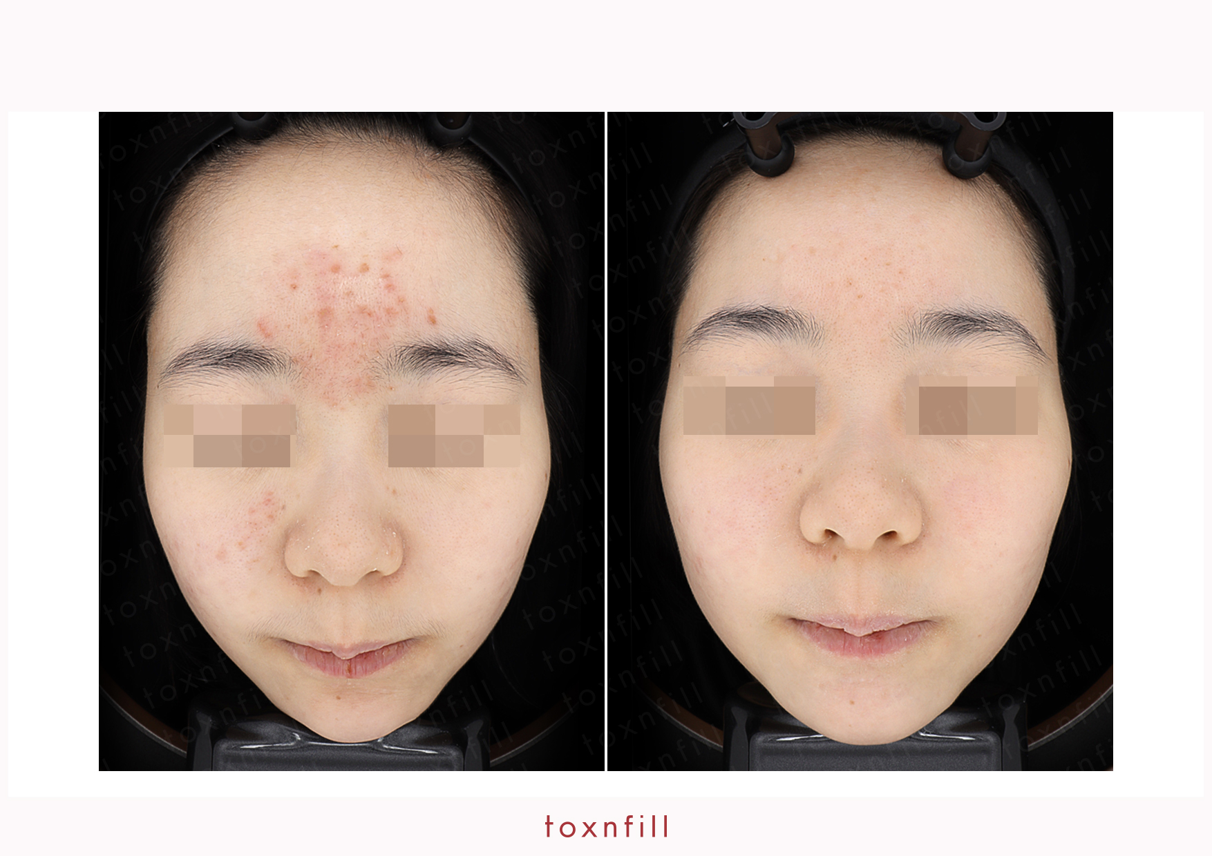 Toxnfill 명동점 실제 시술 결과 보기 (사진은 참고용으로만 사용됨)