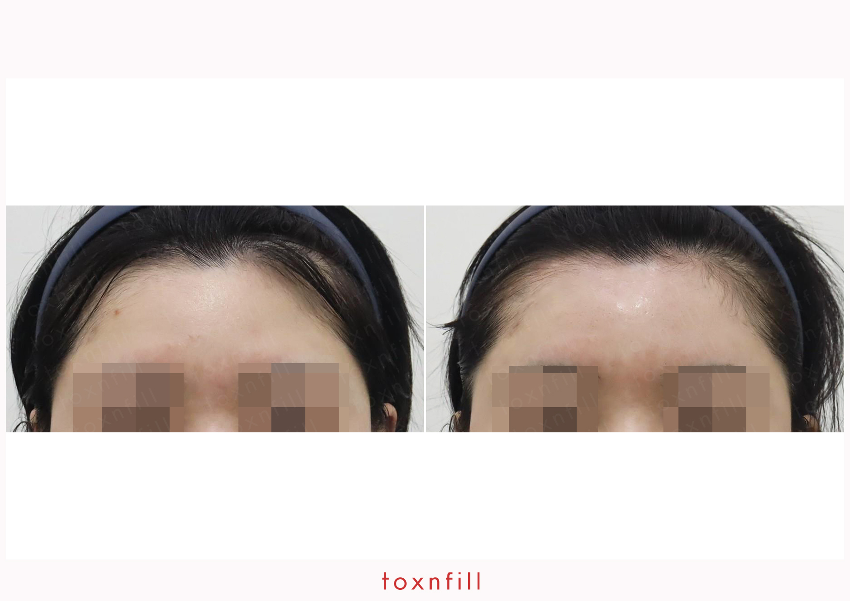 Toxnfill 명동점 이마 충전 수술 전후 비교 (사진은 참고용으로만 사용됨)