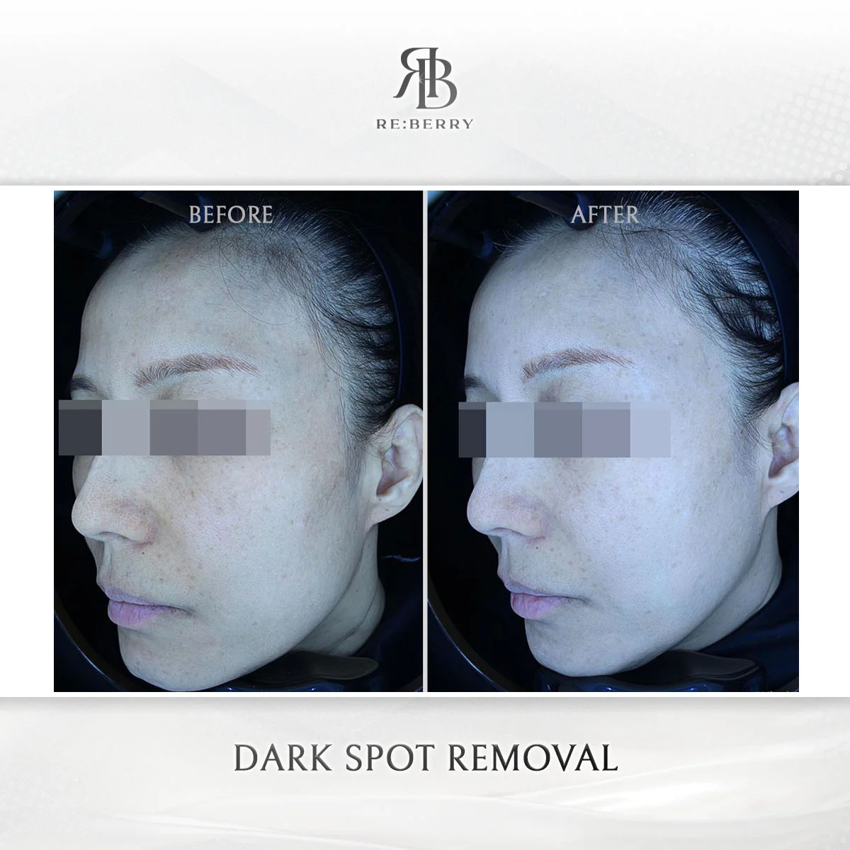 IPL光子嫩膚色斑改善Before-After